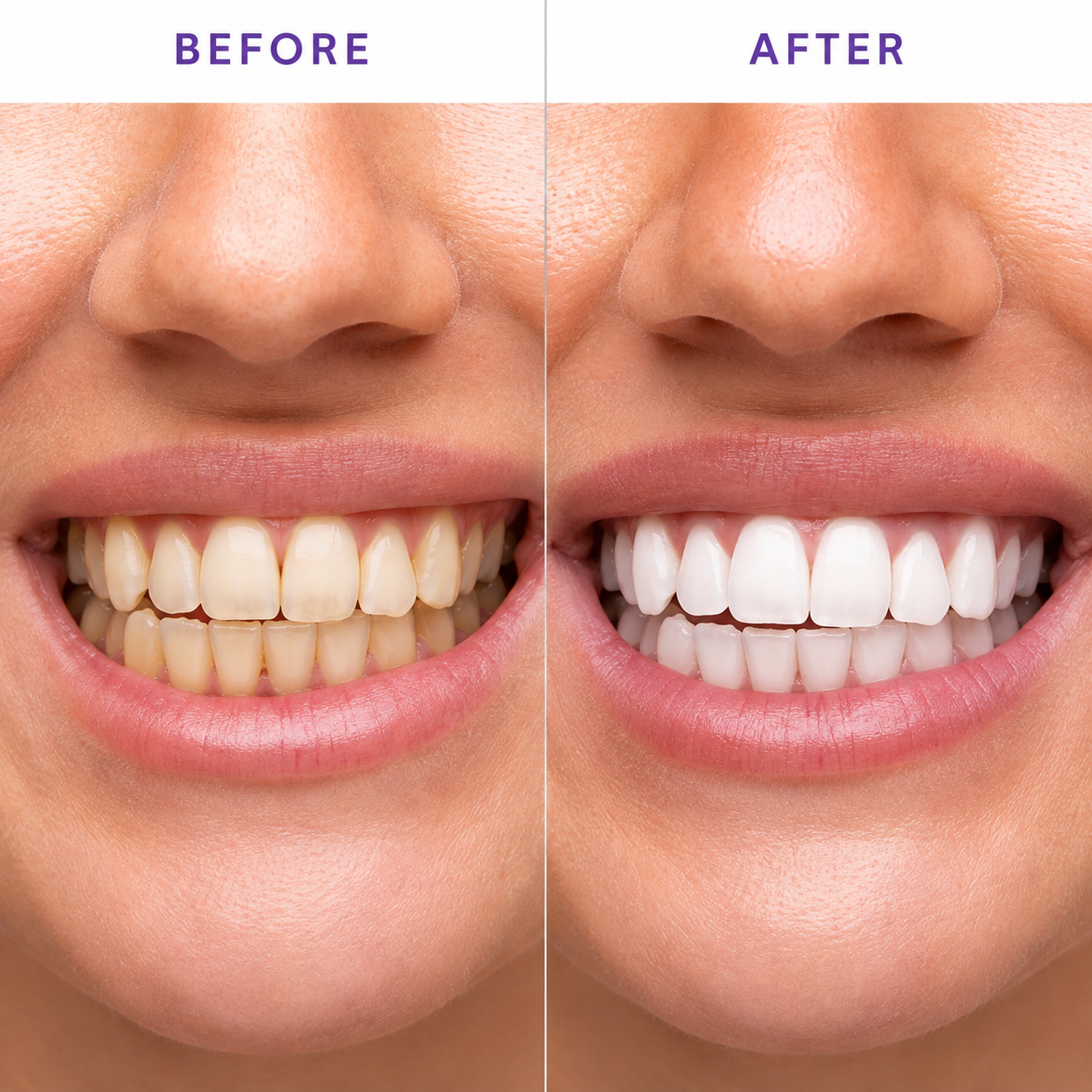 Whitening Strips-Dental Cleaning Marvel