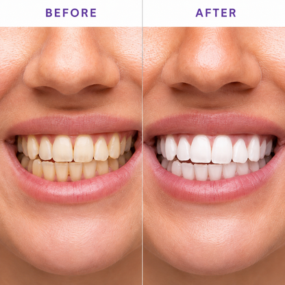 Whitening Strips-Dental Cleaning Marvel